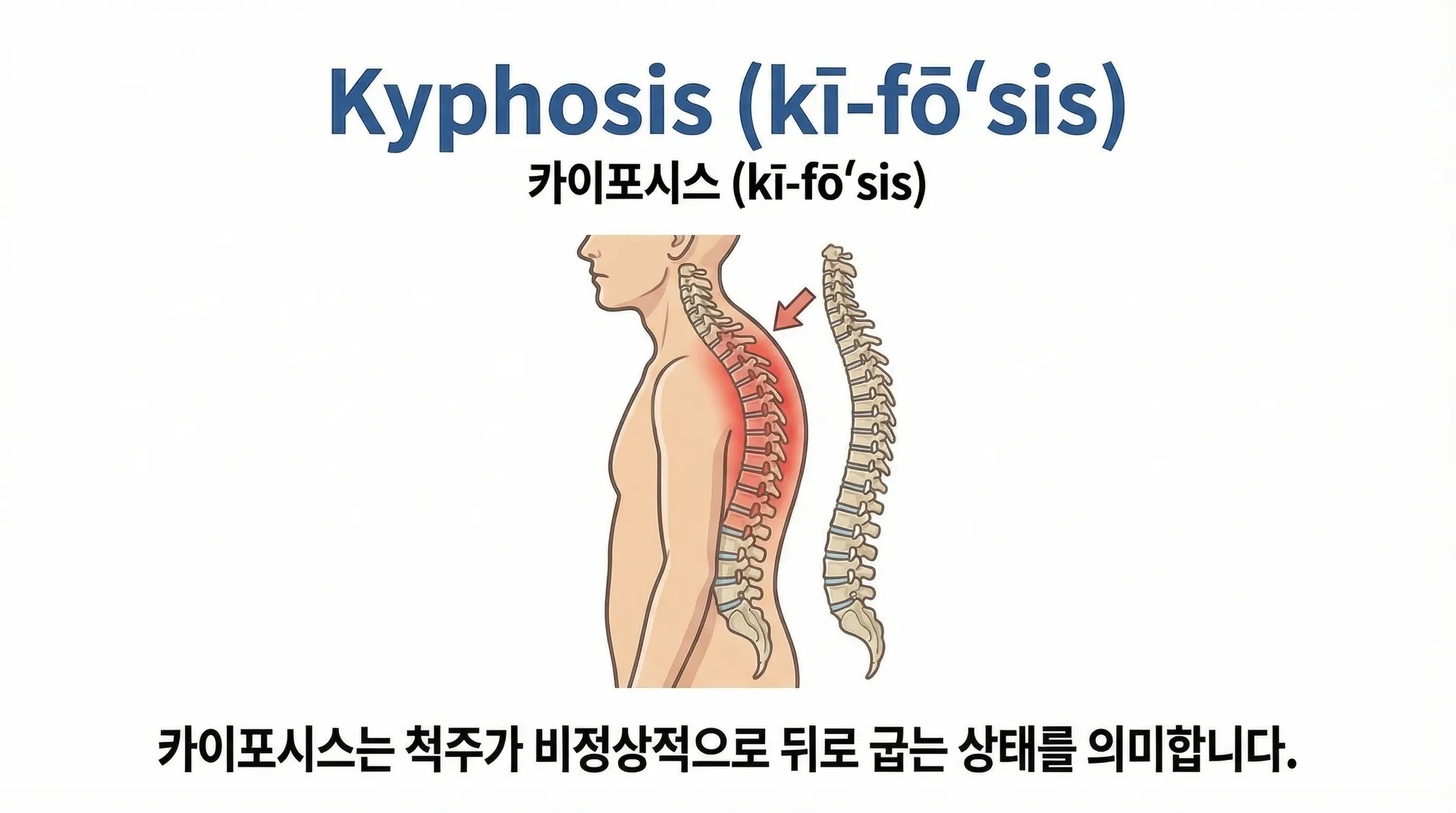 Kyphosis 의학용어 뜻