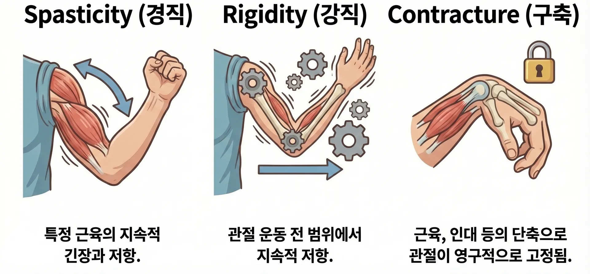 Spasticity(경직), Rigidity(강직), Contracture(구축) 차이점 및 재활에서의 적용법 | 재활지식