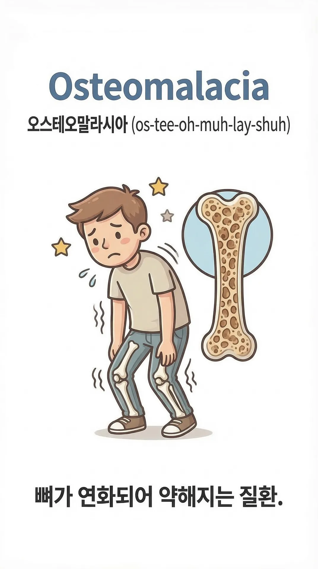 osteomalacia 뜻 | 골연화증, 뼈연화증 의학용어 설명 한글발음 듣기 설명 이미지