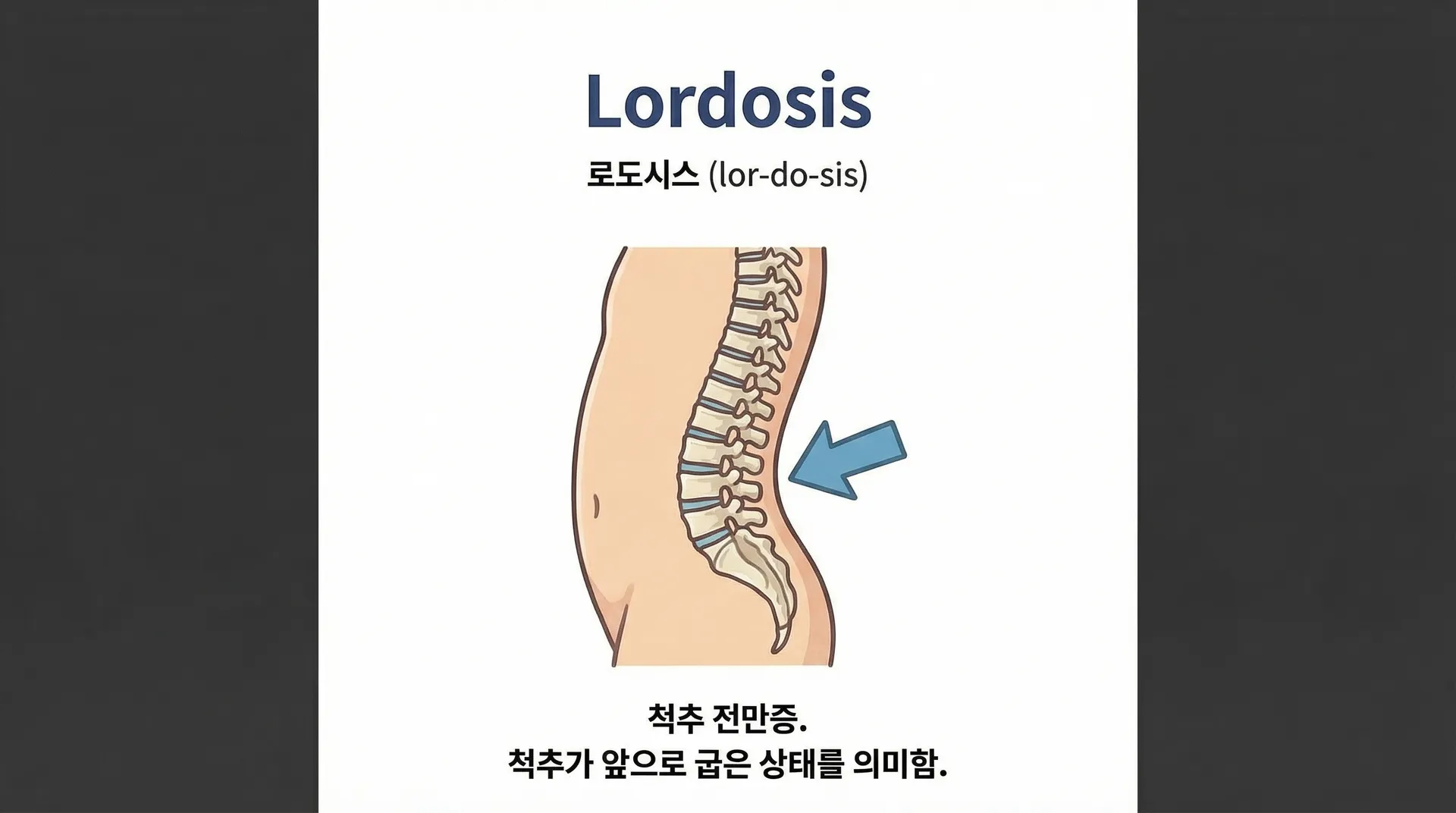 lordosis 의학용어 뜻