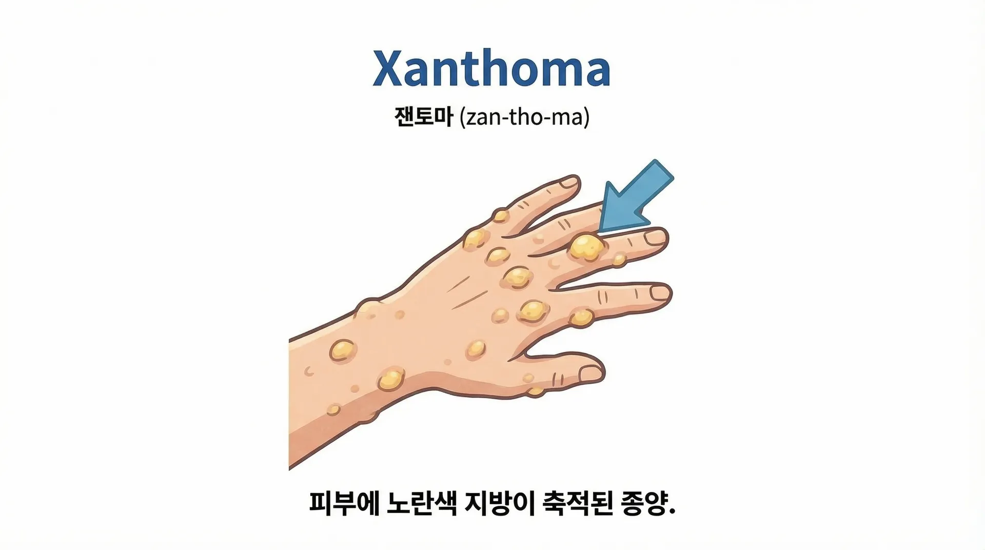 xanthoma 의학용어 뜻