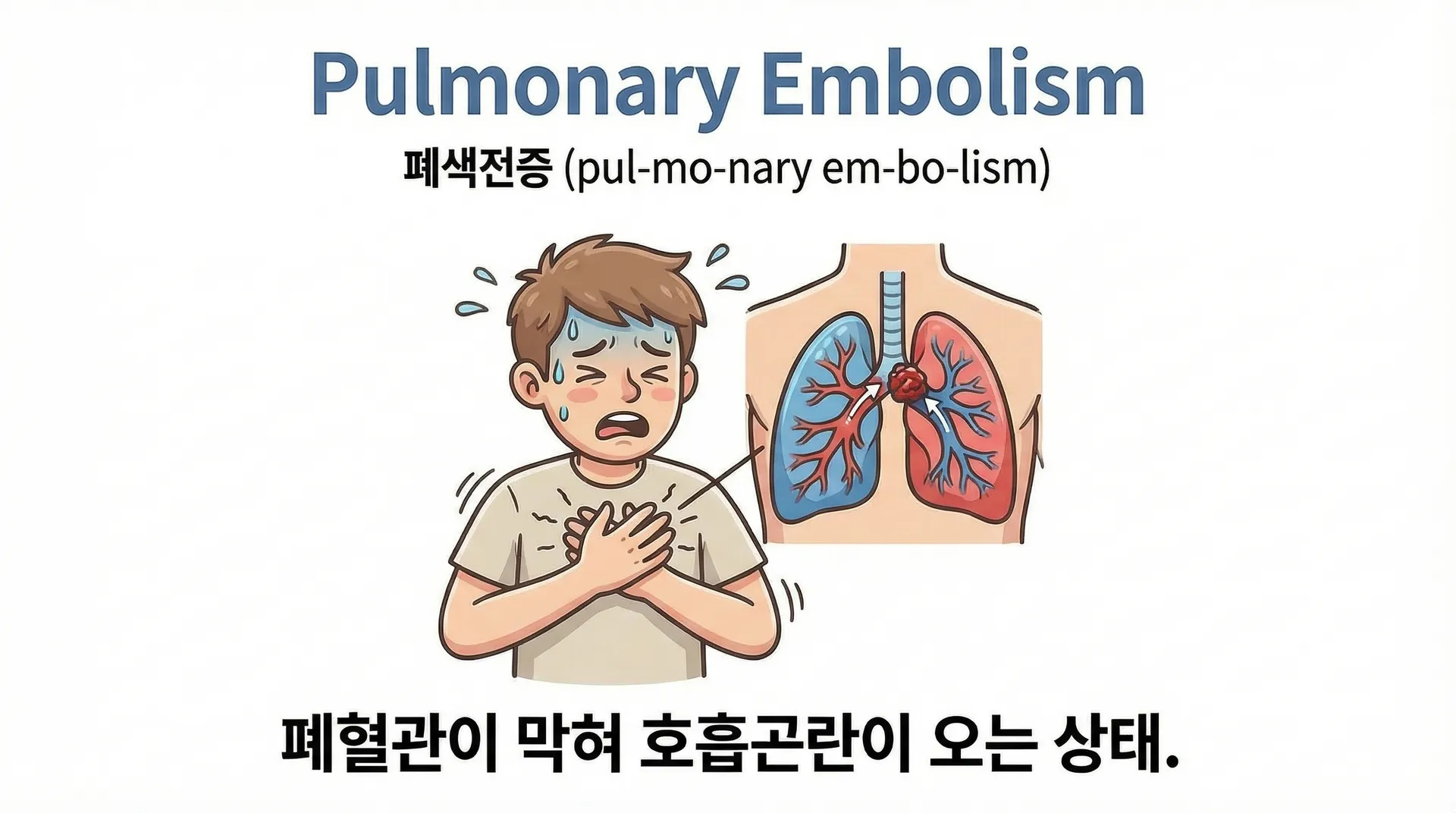 폐색전증