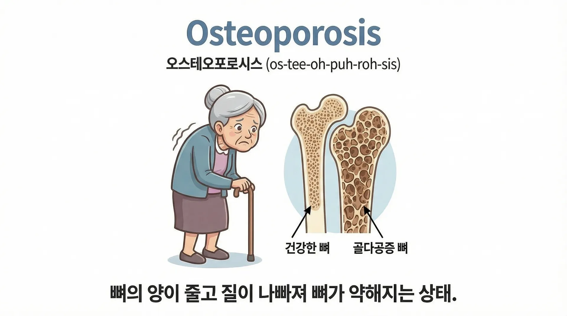 osteoporosis 뜻 | 골다공증 의학용어 설명 한글 발음 듣기 설명 이미지